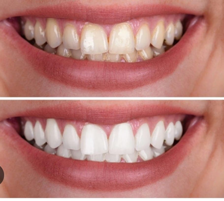 Teeth Bleaching