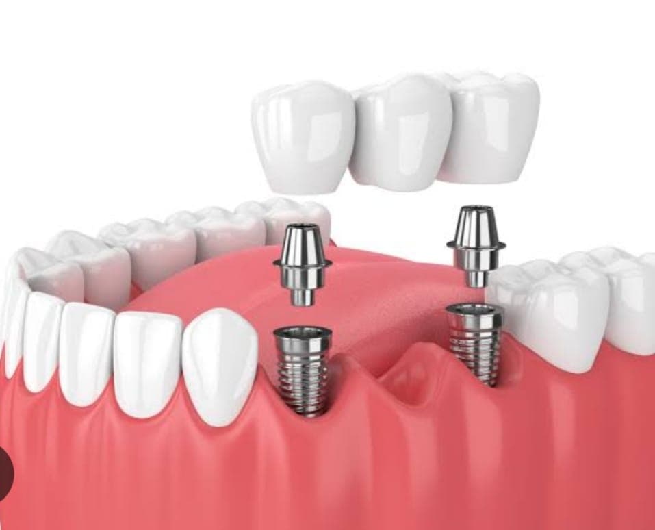 Dental Implants
